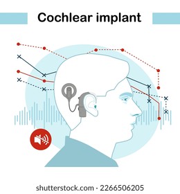 Head with a cochlear implant device in the ear. Cochlear implant device electrically stimulates nerve medical aid ear sound wave adults hard middle exam. Modern vector illustration in flat style