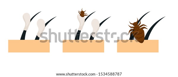 Head Lice Lifecycle Eggs Attached On Stock Vector Royalty Free