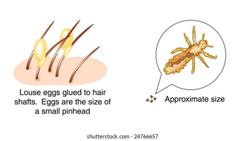 Head Louse Eggs Labeled Stock Vector (Royalty Free) 24766657 | Shutterstock