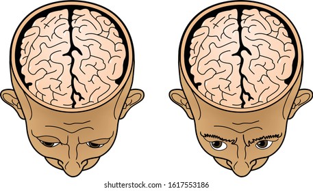 Head Of A Man With An Open Brain Top View. Vector  Illustration.