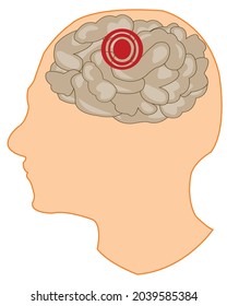 Kopf der Person mit kranzem Gehirn