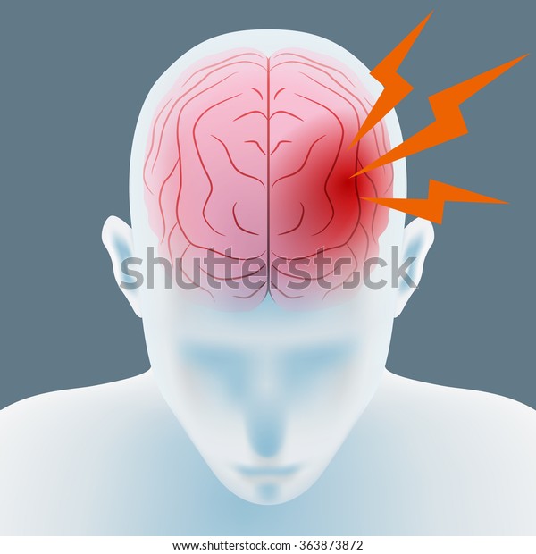 頭痛 脳出血 脳卒中 画像イラスト のベクター画像素材 ロイヤリティフリー