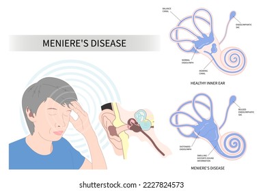 Headache with The Meniere's disease of sound in stuffy ear hear ringing roaring buzzing loss of balance dizzy spells pressure