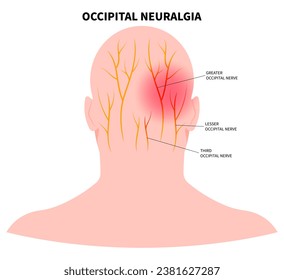 Headache with the occipital neuralgia nerve pain that cause migraine