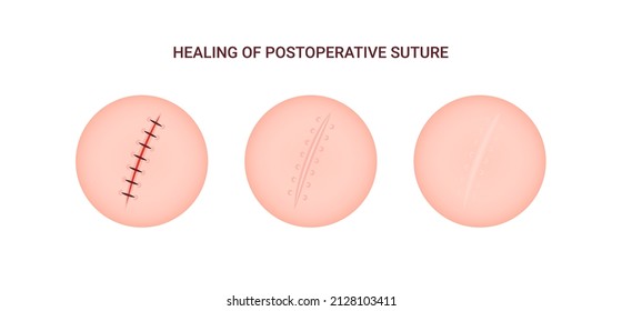 Healing of postoperative suture. Medical infographic. Different human skin scar stages. Vector illustration.