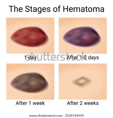 Healing Stages of Bruises and Hematomas