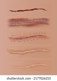 Healing wounds set, skin scars, stitched gash and cuts. Realistic surgical sutures, stitched wounds at different healing stages on human skin background