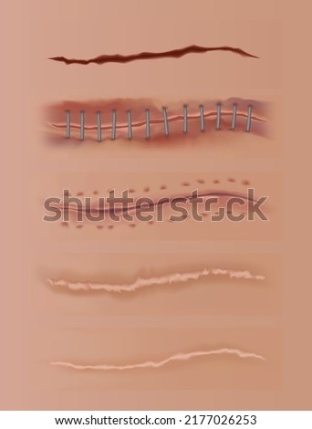 Healing wounds set, skin scars, stitched gash and cuts. Realistic surgical sutures, stitched wounds at different healing stages on human skin background