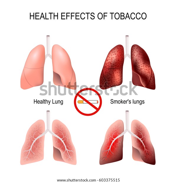 Effets Du Tabagisme Sur La Sante Image Vectorielle De Stock Libre De Droits