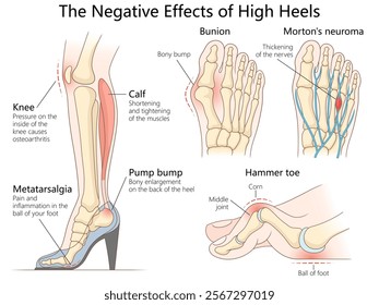 health issues caused by high heels, including bunions, hammer toe, knee pain, and calf muscle strain diagram hand drawn schematic vector illustration. Medical science educational illustration