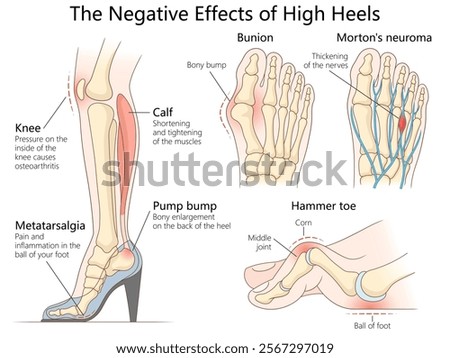 health issues caused by high heels, including bunions, hammer toe, knee pain, and calf muscle strain diagram hand drawn schematic vector illustration. Medical science educational illustration