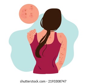 Health Problem, Skin Diseases. Young Woman Showing Her Back With Acne, Red Spots. Teen Girl Scratching Her Shoulder With Pimples.