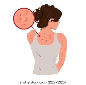 Health problem, skin diseases. Young woman showing her back with acne, red spots. Teen girl scratching her shoulder with pimples.