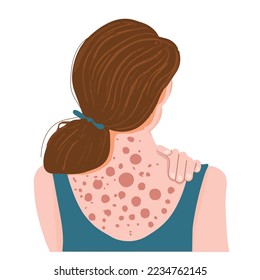 Health problem, skin diseases. Young woman showing her back with acne, red spots. Teen girl scratching her shoulder with pimples.