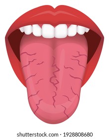 Tongue’s health sign vector illustration ( Cracked Tongue )