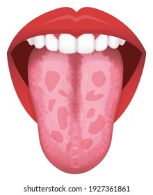 Tongue’s health sign vector illustration ( Geographic Tongue )