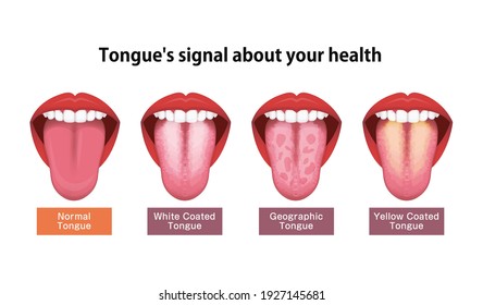 Tongue-Gesundheitszeichen, Vektorgrafik ( Weiße überzogene Zunge )