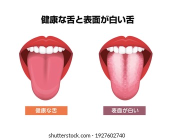 Tongue’s health sign vector illustration ( White coated tongue ). Translation: Normal tongue, White coated tongue.
