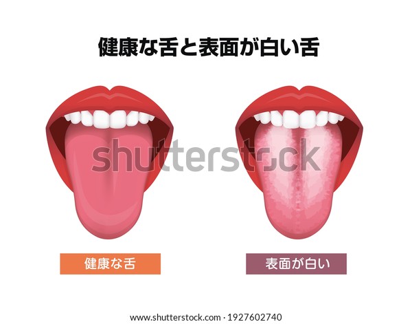 Tongue’s\
health sign vector illustration ( White coated tongue ).\
Translation: Normal tongue, White coated\
tongue.