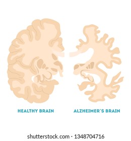 Healthy And Alzheimer Brain. Neurodegeneration Concept. Brain Disease, Memory Loss. Isolated Vector Illustration In Cartoon Style