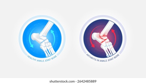 Healthy ankle bone and arthritis or osteoporosis with red blue arrows spin around. Joint cartilage becomes worn. Comparative images of normal and inflammation bones. Vector EPS10.
