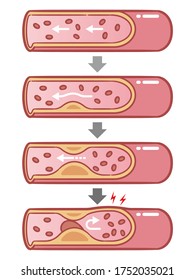 Healthy and atherosclerosis vessels with blood cells vector illustration