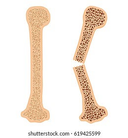 Healthy bone and broken bone with osteoporosis on the white background.