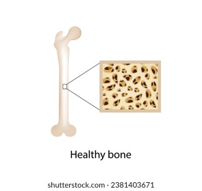 Hueso sano.   Cierre de la densidad de médula ósea (DMO). Proceso de envejecimiento. Osteoporosis, enfermedad ósea. Concepto médico. Ilustración vectorial.