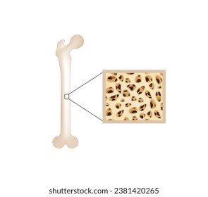 Hueso sano. Cierre de la densidad de médula ósea (DMO). Proceso de envejecimiento. Osteoporosis, enfermedad ósea. Concepto médico. Ilustración vectorial.