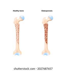 Healthy Bone, And Osteoporosis. Cross Section Of Human's Femur. Vector Illustration