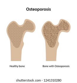 687 Osteoporosis texture Images, Stock Photos & Vectors | Shutterstock