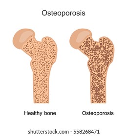 osteomalacia bone
