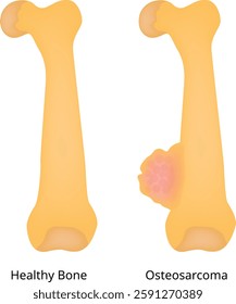 Healthy Bone Osteosarcoma Science Design Vector Illustration Diagram