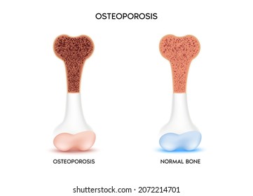 Hueso sano y hueso no sano, Osteoporosis. Concepto médico o de salud. protección ósea. Aislado sobre un fondo blanco. Ilustración realista del vector 3d 