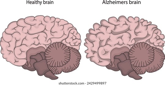 A healthy brain and an Alzheimer's brain.