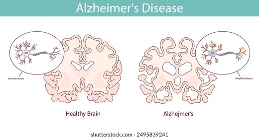 Healthy brain and brain with Alzheimer's disease. Hand drawn illustration.