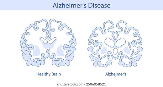 Healthy brain and brain with Alzheimer's disease. Hand drawn illustration.