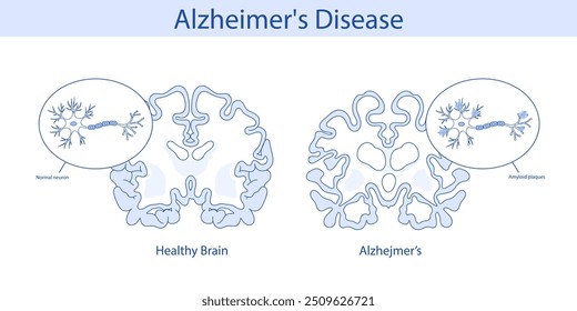 Healthy brain and brain with Alzheimer's disease. Hand drawn illustration.