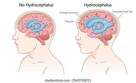 cérebro saudável versus um cérebro com hidrocefalia, ventrículos aumentados, pressão e aumento do tamanho da cabeça diagrama desenhado à mão ilustração vetorial esquemático. Ilustração educacional de ciências médicas