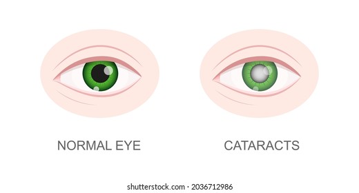 Healthy And Cataract Eye Closeup View. Eyeball With Normal And Cloudy Lens. Anatomically Accurate Human Organ Of Vision. Aging Visual Problems. Vector Cartoon Illustration.