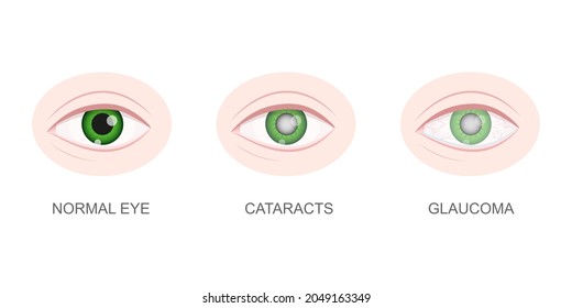 Healthy, cataract and glaucoma eye closeup view. Eyeball with normal and unhealthy lens. Aging visual problems concept. Anatomically detailed human organ of vision. Vector cartoon illustration.