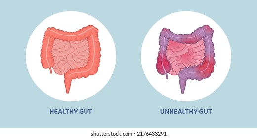 Healthy clean gut and unhealthy inflamed gut comparison