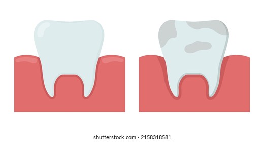Healthy clean tooth and tooth with plaque. Template for stomatology or dentistry.  Dental care Concept. Isolated vector illustration