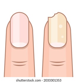 Healthy and damaged finger nails clip art. isolated vector illustration.