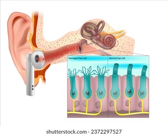 Healthy and damaged hair cells inside cochlea. Noise-induced hearing loss. Tinnitus. 