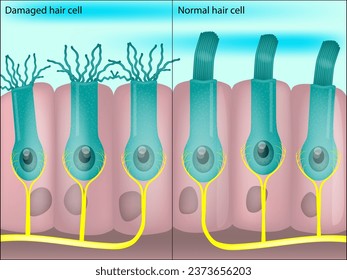 Células capilares sanas y dañadas dentro de la cochlea. Pérdida auditiva inducida por el ruido. Acúfenos. 