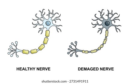 Células nerviosas sanas y dañadas, daño a la vaina de mielina, células sanas y células no sanas, Ilustraciones vectoriales para Elementos médicos, carteles, infografías y ciencia educativa.