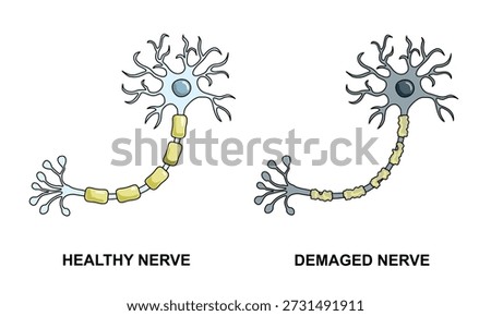 Healthy and damaged nerve cells, damage to the myelin sheath, healthy cells and unhealthy cells, vector illustrations for medical elements, posters, imphographics, and educational science.