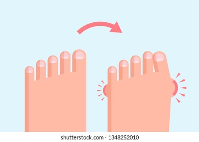 Healthy and deformed feet. Flat feet and hallux valgus