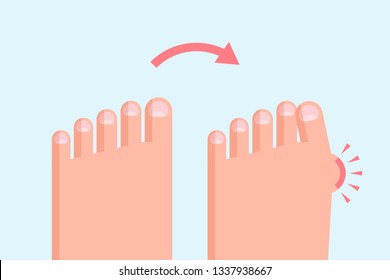 Healthy and deformed feet. Hallux valgus